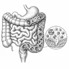 IBD/Ulcerative Colitis