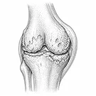 Rheumatoid Arthritis