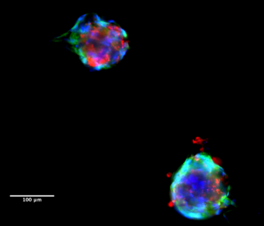 Fluorescent immunofluorescence image of tumoroids with DAPI, alpha-SMA and EpCAM staining in 3D spheroid culture