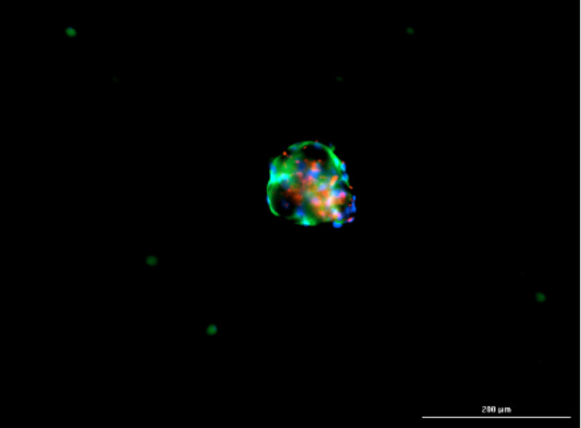 Multichannel fluorescent organoid image showing fibroblast and cancer cell markers at day 3
