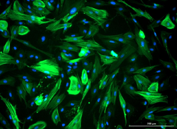 Immunofluorescence image of colon cancer‑associated fibroblasts (CAFs) stained for α‑SMA, highlighting the actin‑positive fibroblast cytoskeleton.