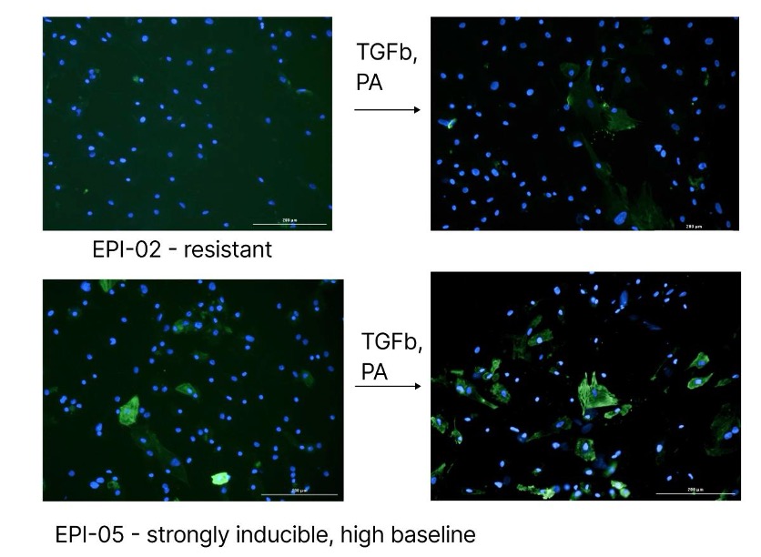 α-SMA immunofluorescence images of primary human epicardial preadipocytes before and after TGF-β and palmitic acid stimulation, showing a resistant response in EPI-02 and strong induction with high baseline α-SMA in EPI-05.