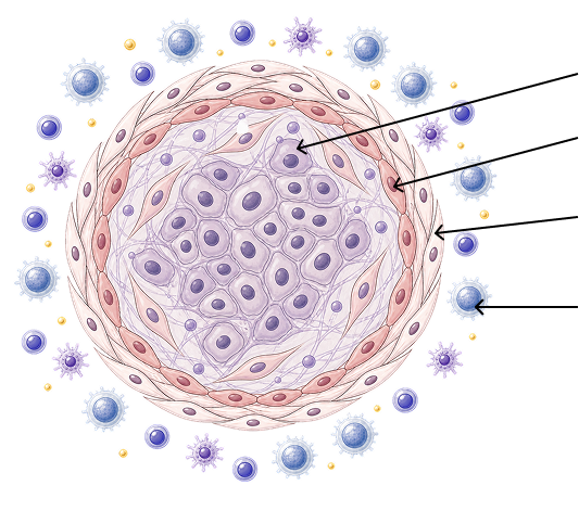 Human tumor assembloid composed of cancer cells, endothelial cells, cancer-associated fibroblasts, and PBMCs